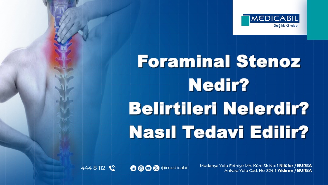 Foraminal Stenoz Nedir? Belirtileri Nelerdir? Nasıl Tedavi Edilir?