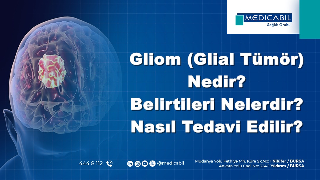 Gliom (Glial Tümör) Nedir? Belirtileri Nelerdir? Nasıl Tedavi Edilir?