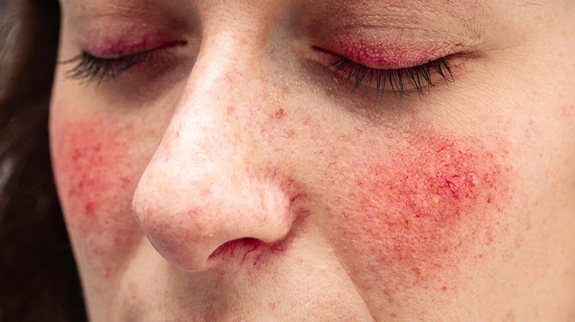 Çfarë Është Sëmundja Rosacea Rose? Cilat Janë Simptomat? Si Të Trajtohet?