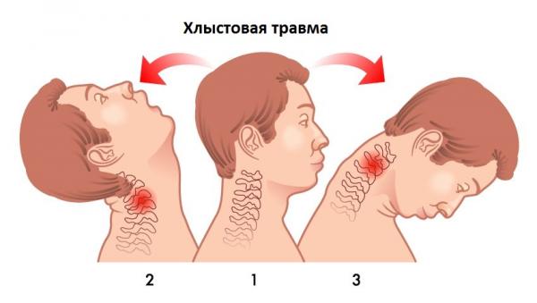 Хлыстовая травма (растяжение шеи)