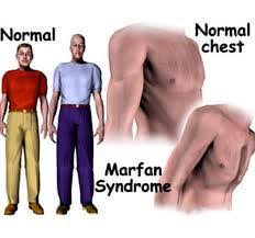 ما هو متلازمة مارفان؟ ما هي أعراضها؟ وكيف يتم علاجها؟