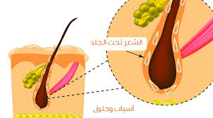 ما هو الكيس الشعري (نمو الشعر تحت الجلد)؟ ما هي الأعراض؟ وكيف يتم علاجه؟