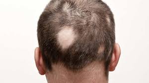 Çfarë Është Ringworm (Alopecia Areata)?