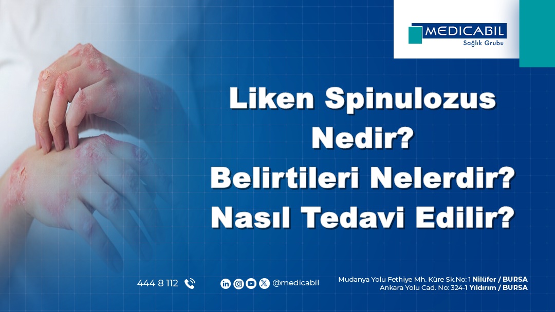 Liken Spinulozus Nedir? Belirtileri Nelerdir? Nasıl Tedavi Edilir?