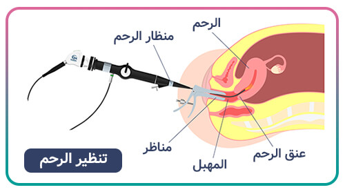 ما هو التنظير الرحمي؟ في أي حالات يتم إجراؤه؟ ما هي المخاطر؟