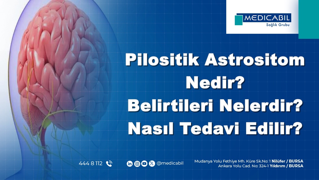 Pilositik Astrositom Nedir? Belirtileri Nelerdir? Nasıl Tedavi Edilir?