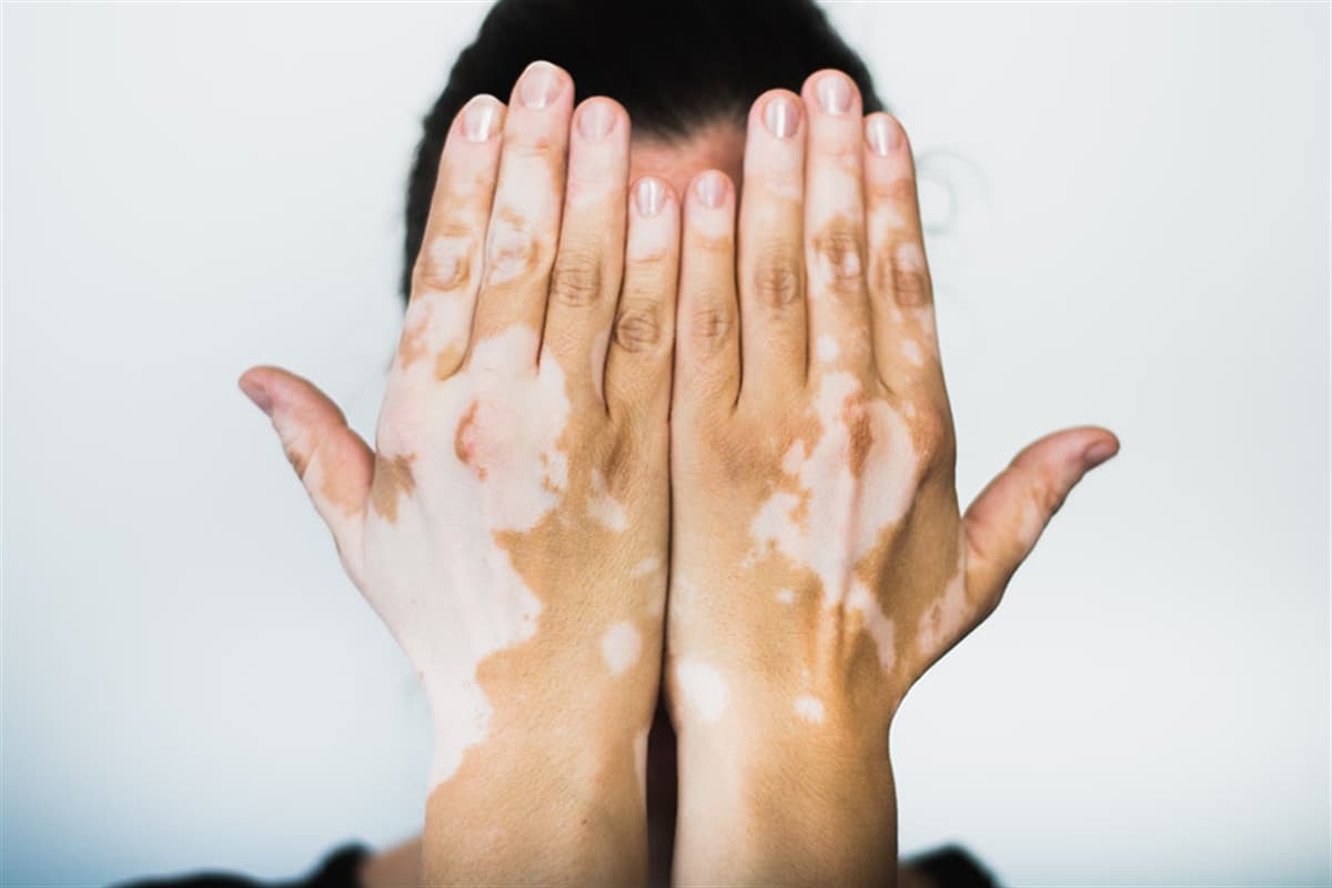 Çfarë Është Vitiligo? Si Të Trajtohet?