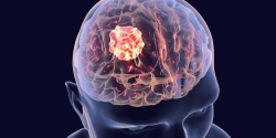  Nöronavigasyon ile Beyin Tümörü Cerrahisi